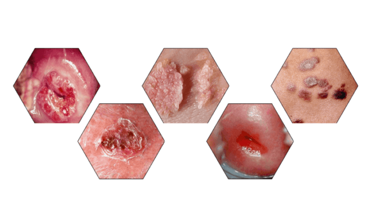 Kāpēc papilomas ir bīstamas