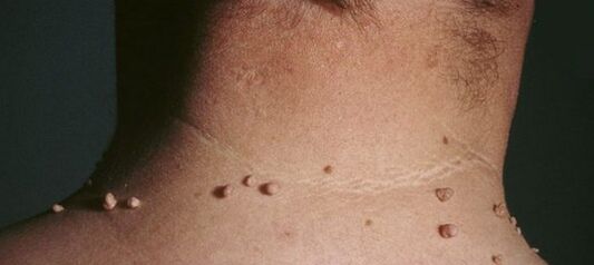 kā atbrīvoties no papillomas