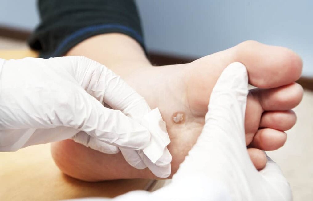 kāpēc uz ķermeņa parādās kārpas