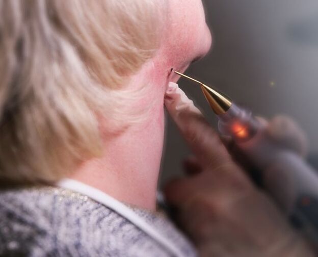 Papilomas noņemšanas process uz sievietes kakla